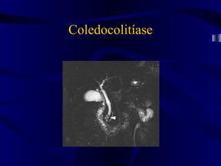 Coledocolitíase
 