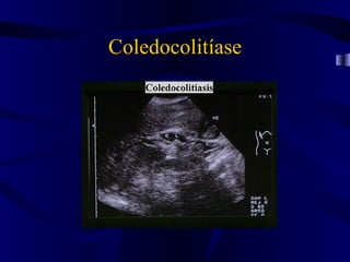 Coledocolitíase
 