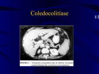 Coledocolitíase
 