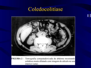 Coledocolitíase
 