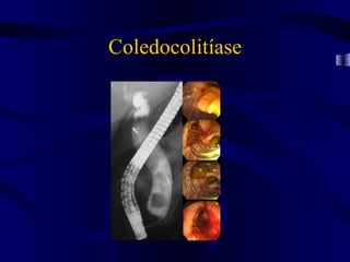 Coledocolitíase
 