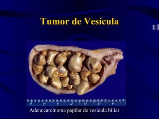 Tumor de Vesícula




Adenocarcinoma papilar de vesícula biliar
 