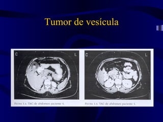 Tumor de vesícula
 