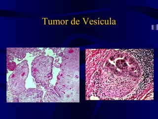 Tumor de Vesícula
 