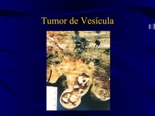 Tumor de Vesícula
 