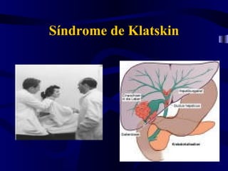 Síndrome de Klatskin
 