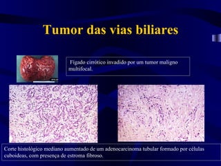 Tumor das vias biliares

                           Fígado cirrótico invadido por um tumor maligno
                           multifocal.




Corte histológico mediano aumentado de um adenocarcinoma tubular formado por células
cuboideas, com presença de estroma fibroso.
 
