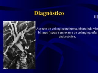 Diagnóstico

Aspecto do colangiocarcinoma, obstruindo vias
 biliares ( setas ) em exame de colangiografia
                   endoscópica.
 