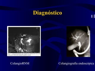 Diagnóstico




ColangioRNM            Colangiografia endoscópica
 