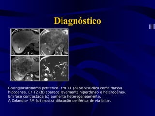 Diagnóstico




Colangiocarcinoma periférico. Em T1 (a) se visualiza como massa
hipodensa. En T2 (b) aparece levemente hiperdenso e heterogêneo.
Em fase contrastada (c) aumenta heterogeneamente.
A Colangio- RM (d) mostra dilatação periférica de via biliar.
 