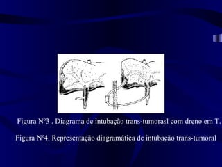 Figura Nº3 . Diagrama de intubação trans-tumorasl com dreno em T.

Figura Nº4. Representação diagramática de intubação trans-tumoral
 