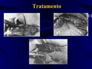 Tratamento
 