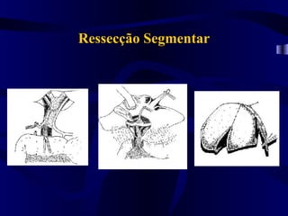 Ressecção Segmentar
 