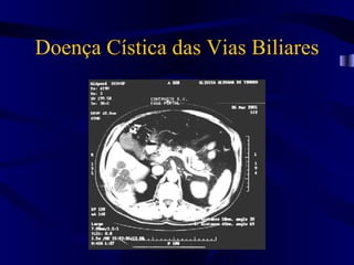 Doença Cística das Vias Biliares
 