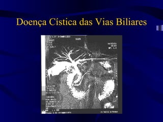 Doença Cística das Vias Biliares
 