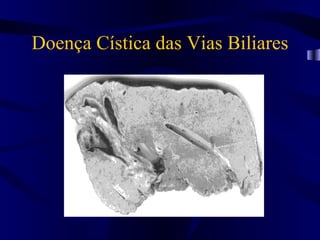Doença Cística das Vias Biliares
 