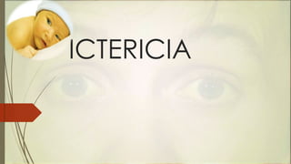 ICTERICIA 
 