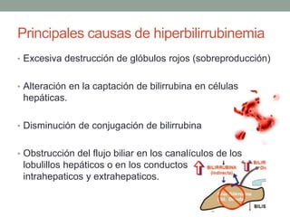 Principales causas de hiperbilirrubinemia
• Excesiva destrucción de glóbulos rojos (sobreproducción)
• Alteración en la captación de bilirrubina en células
hepáticas.
• Disminución de conjugación de bilirrubina
• Obstrucción del flujo biliar en los canalículos de los
lobulillos hepáticos o en los conductos biliares
intrahepaticos y extrahepaticos.
 