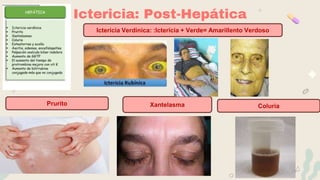 Ictericia: Post-Hepática
Prurito
Ictericia Verdínica: :Ictericia + Verde= Amarillento Verdoso
Xantelasma Coluria
 