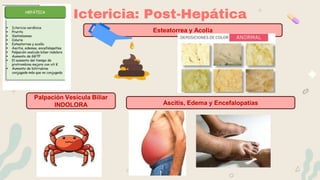 Ictericia: Post-Hepática
Ascitis, Edema y Encefalopatías
Esteatorrea y Acolia
Palpación Vesícula Biliar
INDOLORA
 
