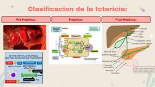 Clasificacion de la Ictericia:
Pre-Hepática: Hepática: Post-Hepática:
 