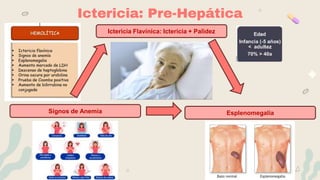 Ictericia: Pre-Hepática
Ictericia Flavínica: Ictericia + Palidez
Esplenomegalia
Signos de Anemia
 