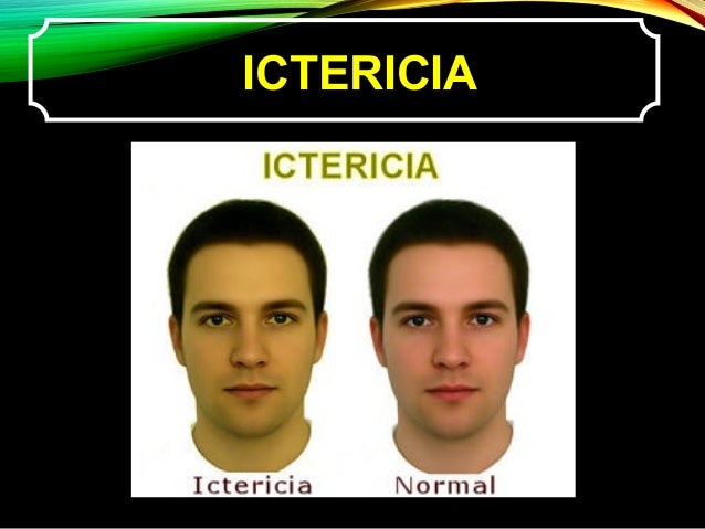 Resultado de imagen de ictericia