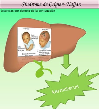 Síndrome de Crigler- Najjar.
Ictericias por defecto de la conjugación
 