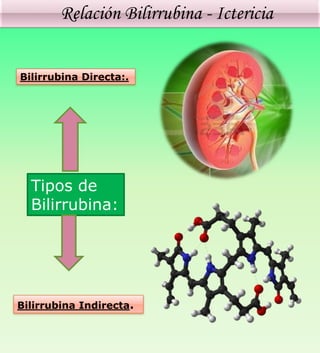 Relación Bilirrubina - Ictericia
Tipos de
Bilirrubina:
Bilirrubina Directa:.
Bilirrubina Indirecta.
 