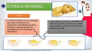 ICTERICIA NEONATAL:
• La ictericia clínica es un concepto
que hace referencia a la
coloración amarillenta de piel y
mucosas, ocasionada por la
impregnación de la piel por la
bilirrubina.
• para algunos autores, alrededor del
60% de los RNTy el 80% de los RNP
desarrollarán ictericia en la primera
semana de vida
Concepto:
https://www.pediatriaintegral.es/wp-content/uploads/2014/xviii06/03/367-374.pdf
 