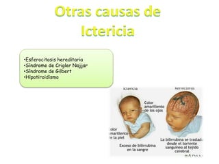 •Esferocitosis hereditaria
•Síndrome de Crigler Najjar
•Síndrome de Gilbert
•Hipotiroidismo
 