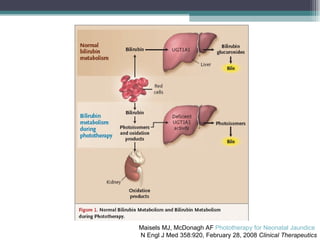 Maisels MJ, McDonagh AF  Phototherapy for Neonatal Jaundice   N Engl J Med 358:920, February 28, 2008  Clinical Therapeutics 