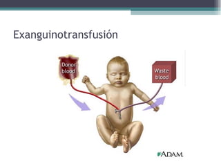 Exanguinotransfusión 
