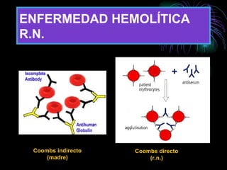 ENFERMEDAD HEMOLÍTICA R.N. Coombs indirecto (madre) Coombs directo (r.n.) 