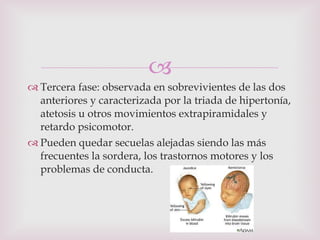 Tercera fase: observada en sobrevivientes de las dos anteriores y caracterizada por la triada de hipertonía, atetosis u otros movimientos extrapiramidales y retardo psicomotor. Pueden quedar secuelas alejadas siendo las más frecuentes la sordera, los trastornos motores y los problemas de conducta. 