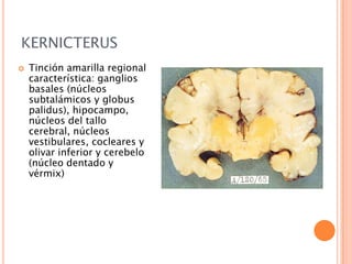 KERNICTERUS


Tinción amarilla regional
característica: ganglios
basales (núcleos
subtalámicos y globus
palidus), hipocampo,
núcleos del tallo
cerebral, núcleos
vestibulares, cocleares y
olivar inferior y cerebelo
(núcleo dentado y
vérmix)

 
