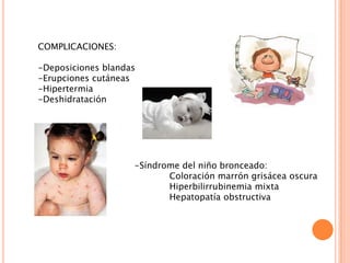 COMPLICACIONES:
-Deposiciones blandas
-Erupciones cutáneas
-Hipertermia
-Deshidratación

-Síndrome del niño bronceado:
Coloración marrón grisácea oscura
Hiperbilirrubinemia mixta
Hepatopatía obstructiva

 