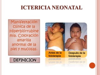 ICTERICIA NEONATAL
DEFINICION
Manifestación
clínica de la
Hiperbilirrubine
mia. Coloración
amarilla
anormal de la
piel y mucosas.
 