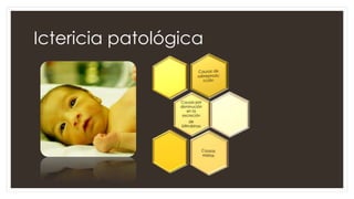 Ictericia patológica
 