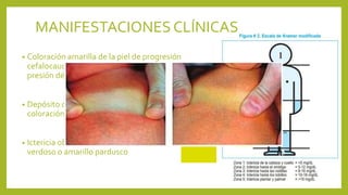 • Coloración amarilla de la piel de progresión
cefalocaudal. Puede verse también con
presión dérmica.
• Depósito de bilirrubina indirecta 
coloración amarilla brillante o anaranjada
• Ictericia obstructiva (bilirrubina directa) 
verdoso o amarillo pardusco
MANIFESTACIONESCLÍNICAS
 