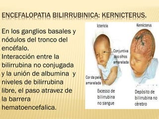 ENCEFALOPATIA BILIRRUBINICA: KERNICTERUS.
En los ganglios basales y
nódulos del tronco del
encéfalo.
Interacción entre la
bilirrubina no conjugada
y la unión de albumina y
niveles de bilirrubina
libre, el paso atravez de
la barrera
hematoencefalica.
 