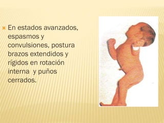  En estados avanzados,
espasmos y
convulsiones, postura
brazos extendidos y
rígidos en rotación
interna y puños
cerrados.
 