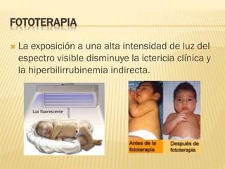 FOTOTERAPIA
 La exposición a una alta intensidad de luz del
espectro visible disminuye la ictericia clínica y
la hiperbilirrubinemia indirecta.
 