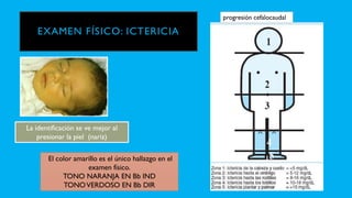 EXAMEN FÍSICO: ICTERICIA
La identificación se ve mejor al
presionar la piel (nariz)
progresión cefalocaudal
El color amarillo es el único hallazgo en el
examen físico.
TONO NARANJA EN Bb IND
TONOVERDOSO EN Bb DIR
 