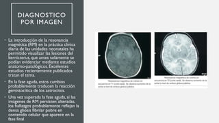 DIAGNOSTICO
POR IMAGEN
• La introducción de la resonancia
magnética (RM) en la práctica clínica
diaria de las unidades neonatales ha
permitido visualizar las lesiones del
kernicterus, que antes solamente se
podían evidenciar mediante estudios
anatomo-patológicos. Excelentes
estudios recientemente publicados
tratan el tema.
• En la fase aguda, estos cambios
probablemente traducen la reacción
gemistocítica de los astrocitos.
• Una vez superada la fase aguda, si las
imágenes de RM persisten alteradas,
los hallazgos probablemente reflejan la
densa gliosis fibrilar pobre en
contenido celular que aparece en la
fase final
 