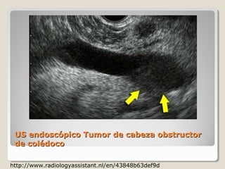 US endoscópico Tumor de cabeza obstructor
 de colédoco

http://www.radiologyassistant.nl/en/43848b63def9d
 