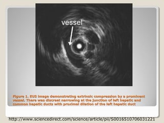 Figure 1. EUS image demonstrating extrinsic compression by a prominent
 vessel. There was discreet narrowing at the junction of left hepatic and
 common hepatic ducts with proximal dilation of the left hepatic duct



http://www.sciencedirect.com/science/article/pii/S0016510706031221
 