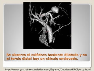 Se observa el colédoco bastante dilatado y en
 el tercio distal hay un cálculo enclavado.


http://www.gastrointestinalatlas.com/Espanol/Duodeno/ERCP/ercp.html
 