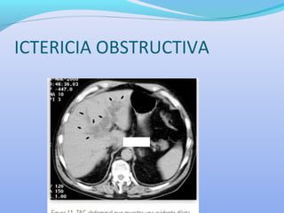 ICTERICIA OBSTRUCTIVA
 