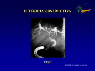 ICTERICIA OBSTRUCTIVA
CPRE
FUENTE: Dra. Casilli , A. (2010)
 